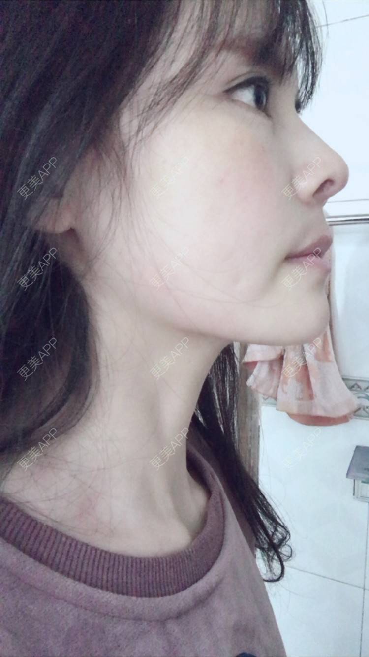 更美 - 喵星球上的女王的鼻翼缩小经验 | 北京 | 朝天鼻矫正手术 | 鼻翼缩小