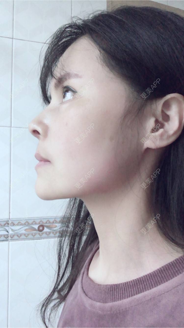 更美 - 喵星球上的女王的鼻翼缩小经验 | 北京 | 朝天鼻矫正手术 | 鼻翼缩小