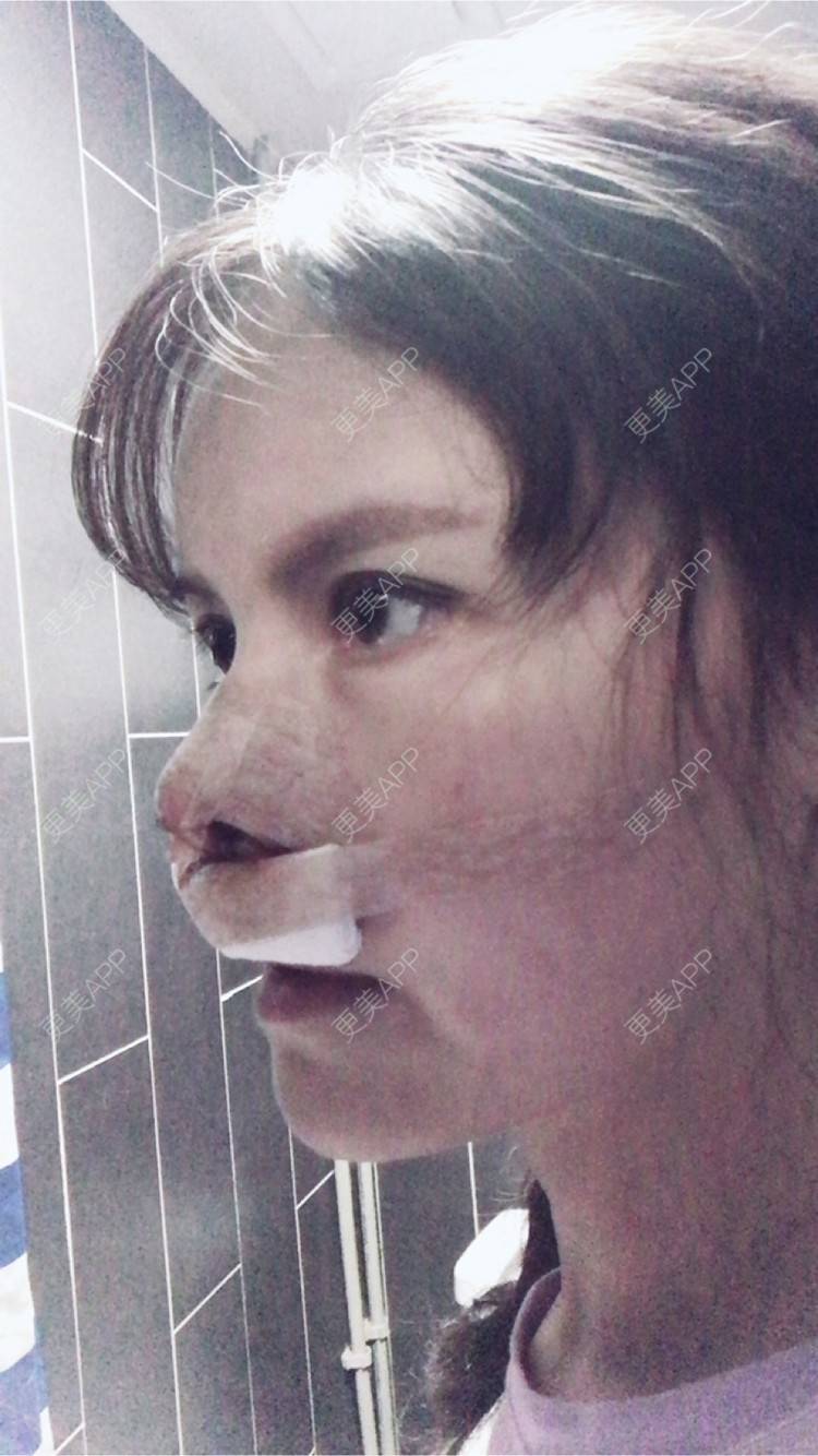 更美 - 喵星球上的女王的鼻翼缩小经验 | 北京 | 朝天鼻矫正手术 | 鼻翼缩小