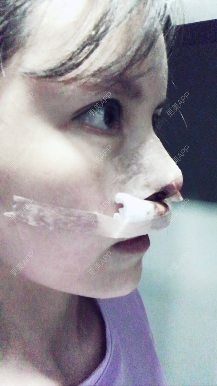 更美 - 喵星球上的女王的鼻翼缩小经验 | 北京 | 朝天鼻矫正手术 | 鼻翼缩小