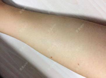 更美 - 更美用户iuP9YFejM1的手臂脱毛经验 | 手臂脱毛 | 广州