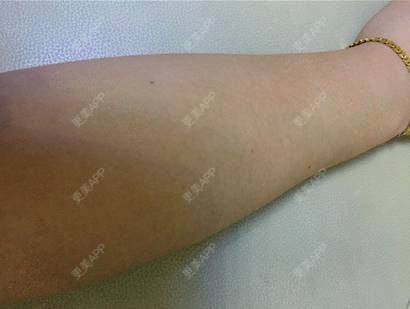 更美 - 更美用户iuP9YFejM1的手臂脱毛经验 | 手臂脱毛 | 广州