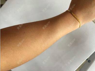 更美 - 更美用户iuP9YFejM1的手臂脱毛经验 | 手臂脱毛 | 广州