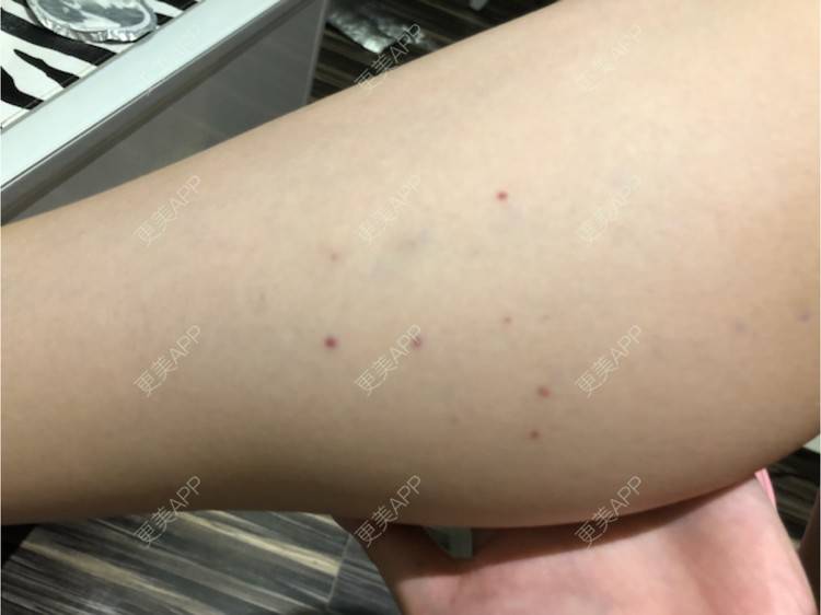 更美 - 更美用户Bsp3Jo3Eeh的注射塑形腿部经验 | 长沙 | 北京 | 水光项目 | 双眼皮 | 上海 | 鼻部综合 | 武汉 | 广州 | 玻尿酸导入 | 深圳 | 吸脂 | 玻尿酸 | 微笑唇手术 | 西安 | 激光脱毛 | 杭州 | 玻尿酸溶解酶 | 注射塑形腿部 | 除皱瘦脸 | 埋线提升 | 皮秒激光 | 哈尔滨 | 全切双眼皮 | 汕头