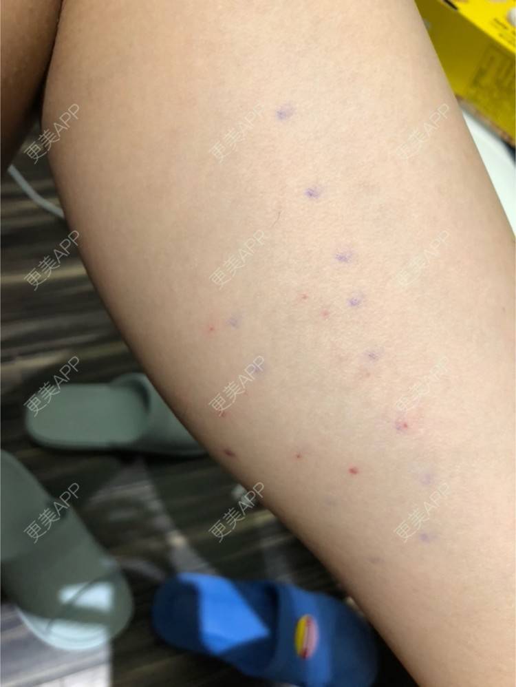 更美 - 更美用户Bsp3Jo3Eeh的注射塑形腿部经验 | 长沙 | 北京 | 水光项目 | 双眼皮 | 上海 | 鼻部综合 | 武汉 | 广州 | 玻尿酸导入 | 深圳 | 吸脂 | 玻尿酸 | 微笑唇手术 | 西安 | 激光脱毛 | 杭州 | 玻尿酸溶解酶 | 注射塑形腿部 | 除皱瘦脸 | 埋线提升 | 皮秒激光 | 哈尔滨 | 全切双眼皮 | 汕头