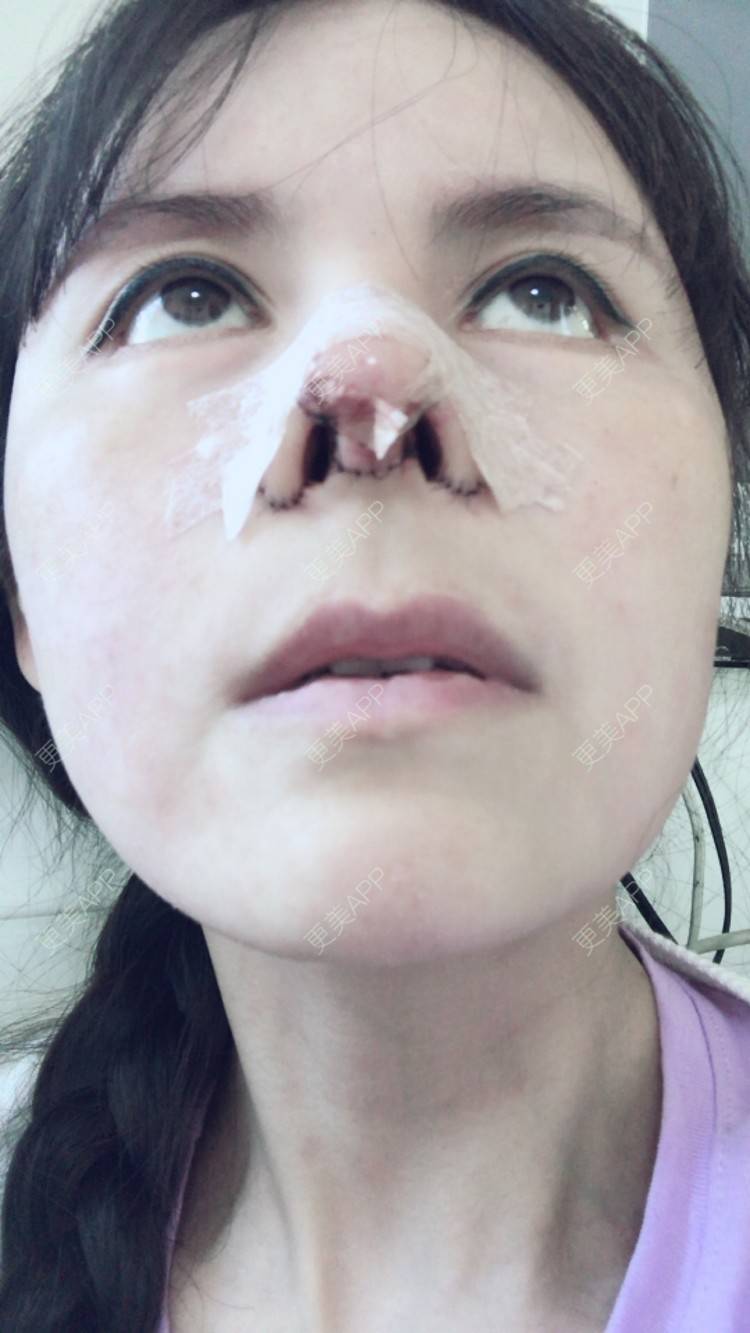 更美 - 喵星球上的女王的鼻翼缩小经验 | 朝天鼻矫正手术 | 北京 | 鼻翼缩小