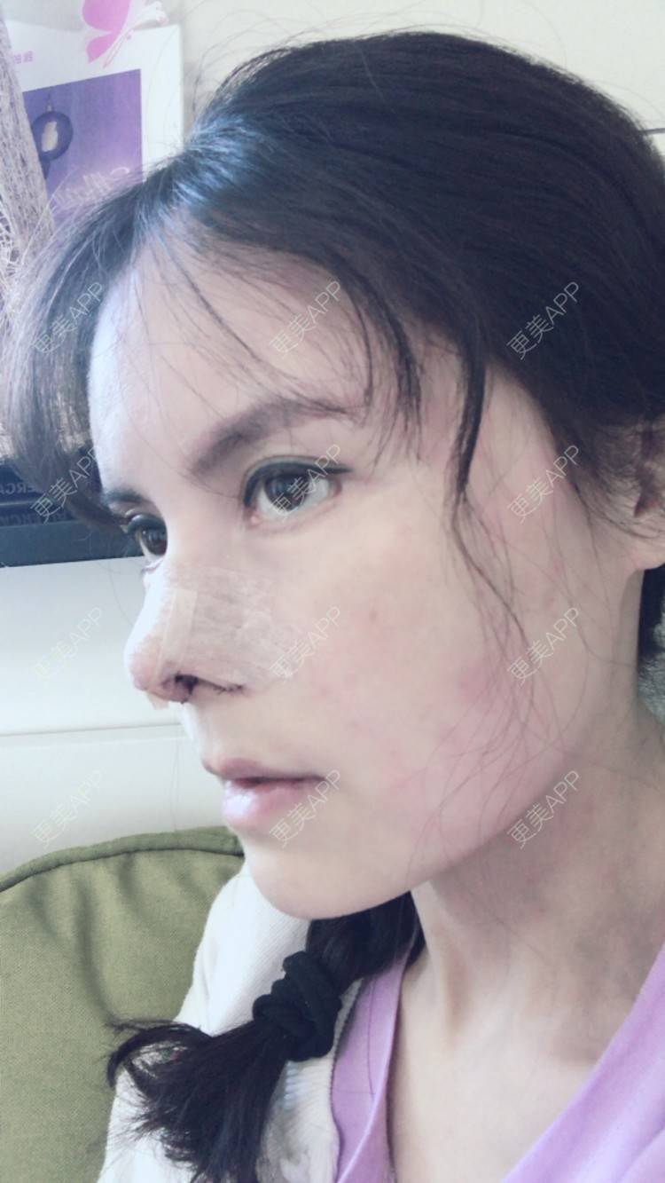 更美 - 喵星球上的女王的鼻翼缩小经验 | 朝天鼻矫正手术 | 北京 | 鼻翼缩小