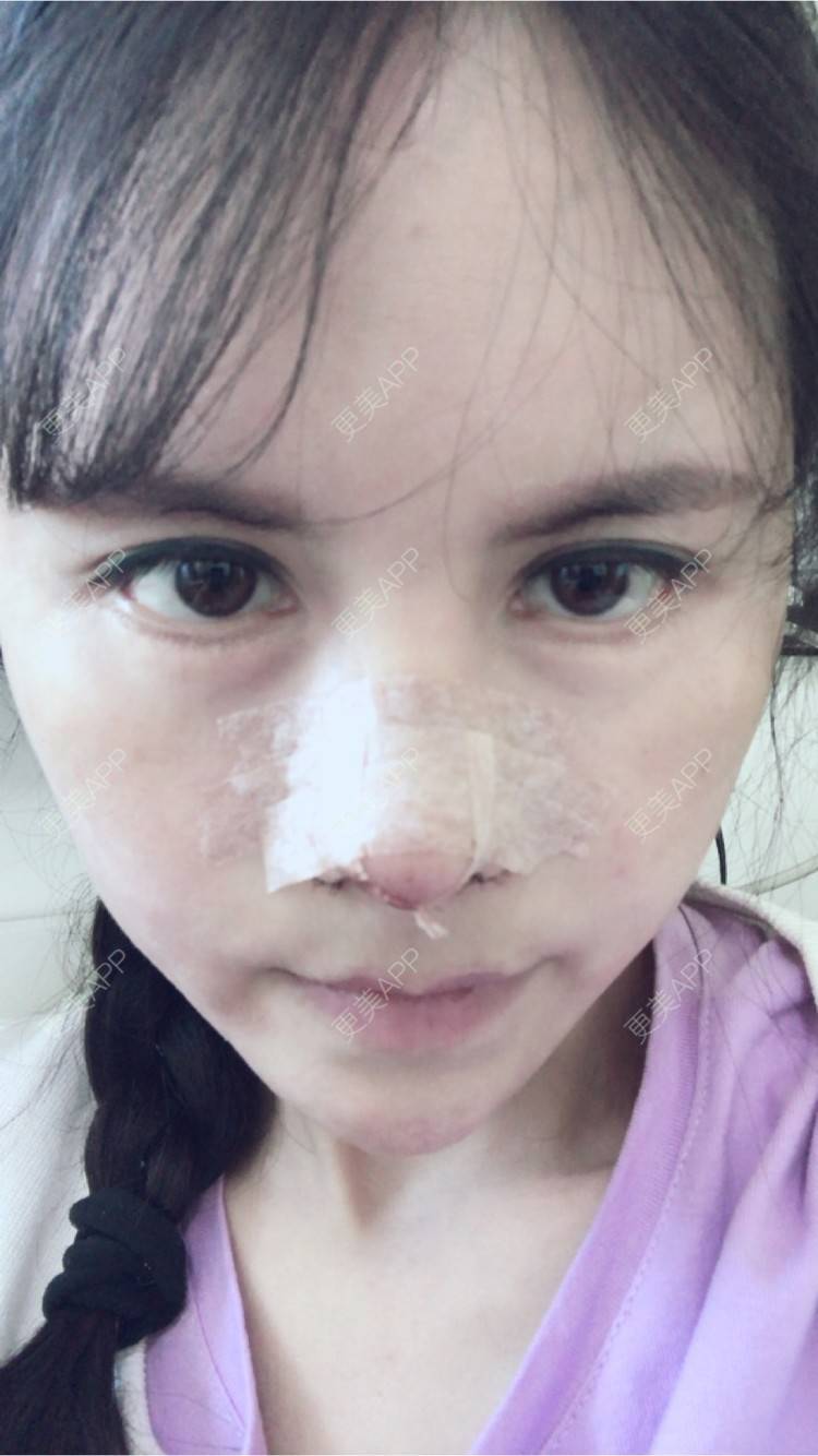 更美 - 喵星球上的女王的鼻翼缩小经验 | 朝天鼻矫正手术 | 北京 | 鼻翼缩小