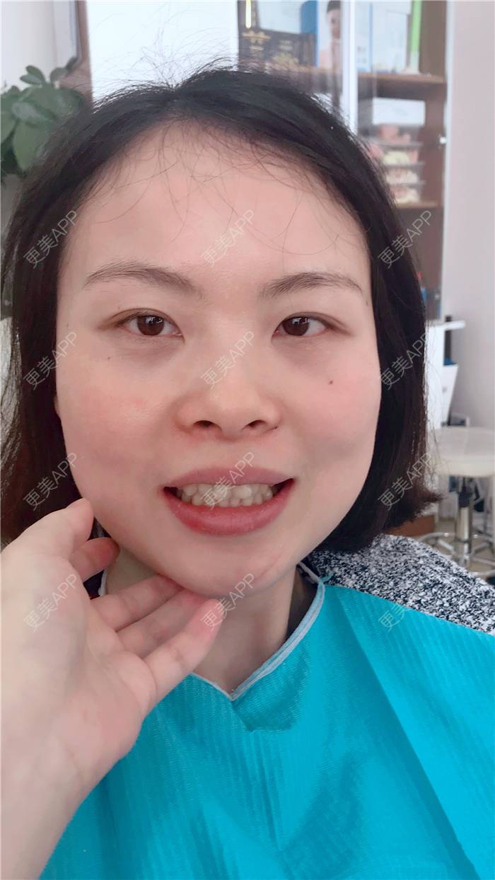 牙齿矫正效果图_不必讲理掷反牙齿矫正效果图_术后59天__更美