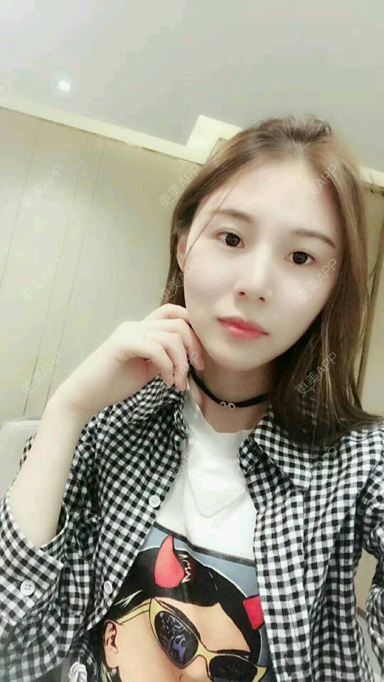 更美 - xNz3B婷的歪鼻矫正经验 | 上海 | 歪鼻矫正
