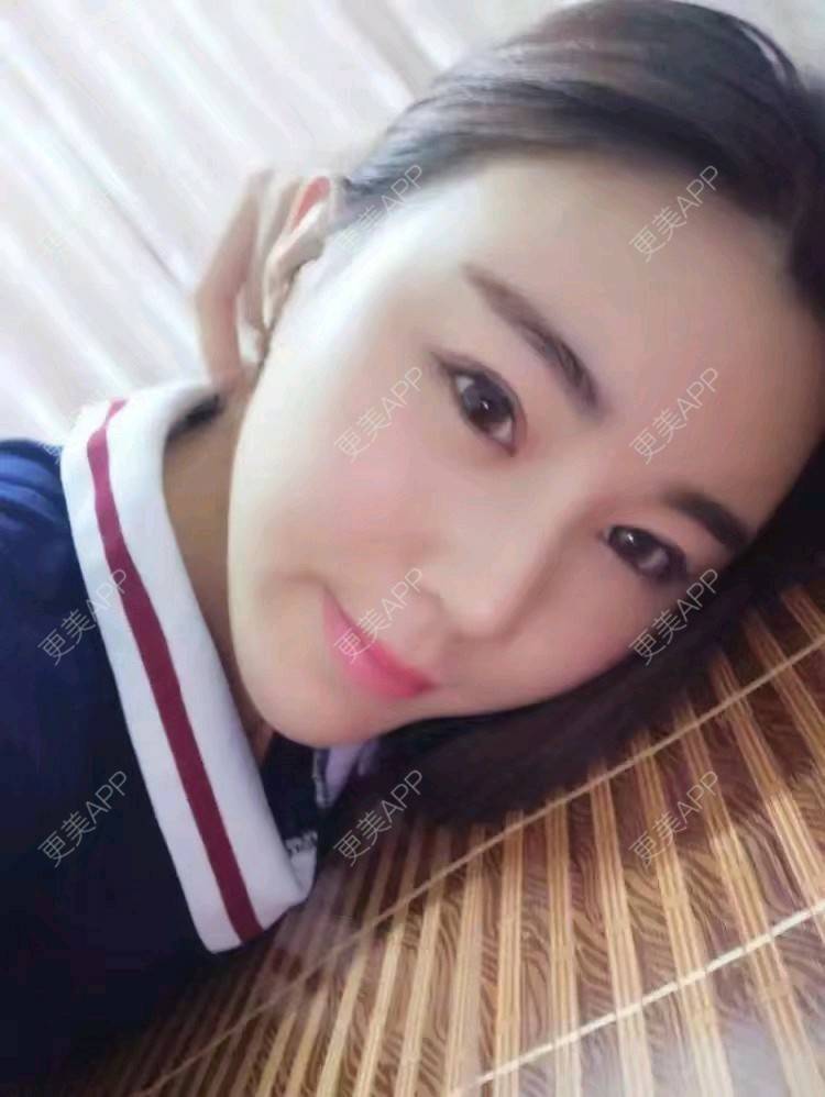 更美 - 打不过我吧的硅胶隆鼻经验 | 硅胶隆鼻 | 濮阳