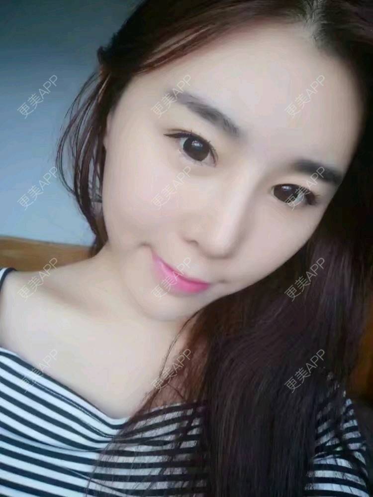 更美 - 打不过我吧的硅胶隆鼻经验 | 硅胶隆鼻 | 濮阳