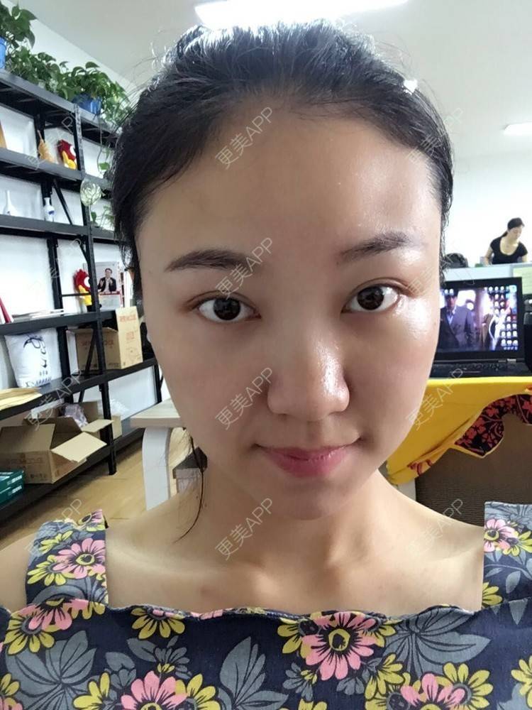更美 - 刘文峰 医生的内切去眼袋经验 | 内切去眼袋
