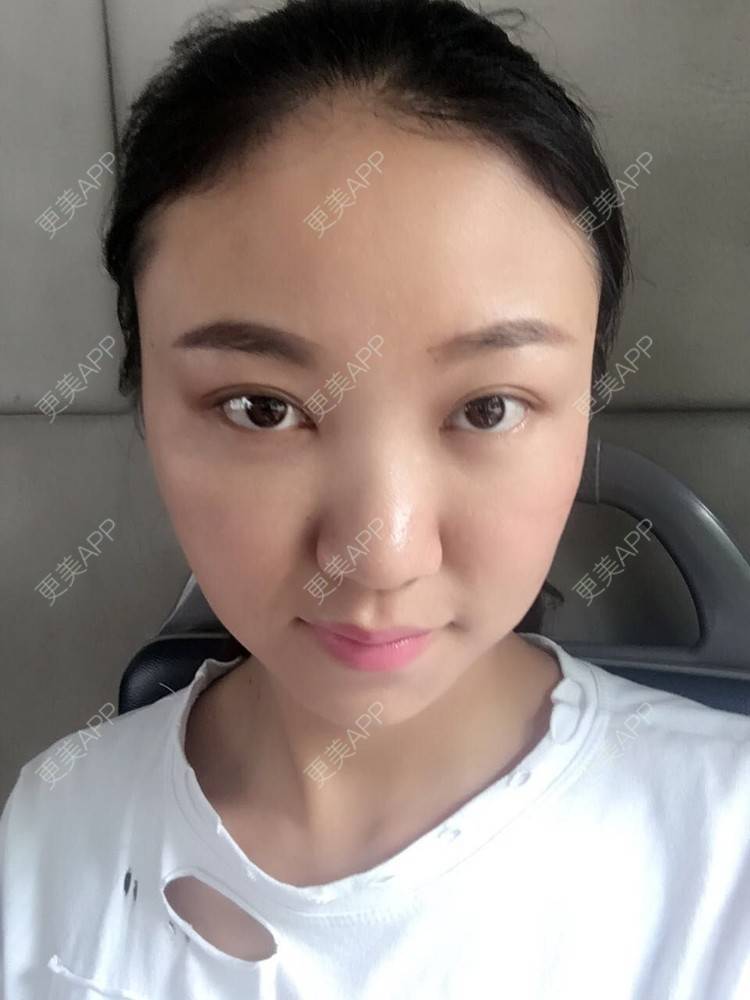 更美 - 刘文峰 医生的内切去眼袋经验 | 内切去眼袋