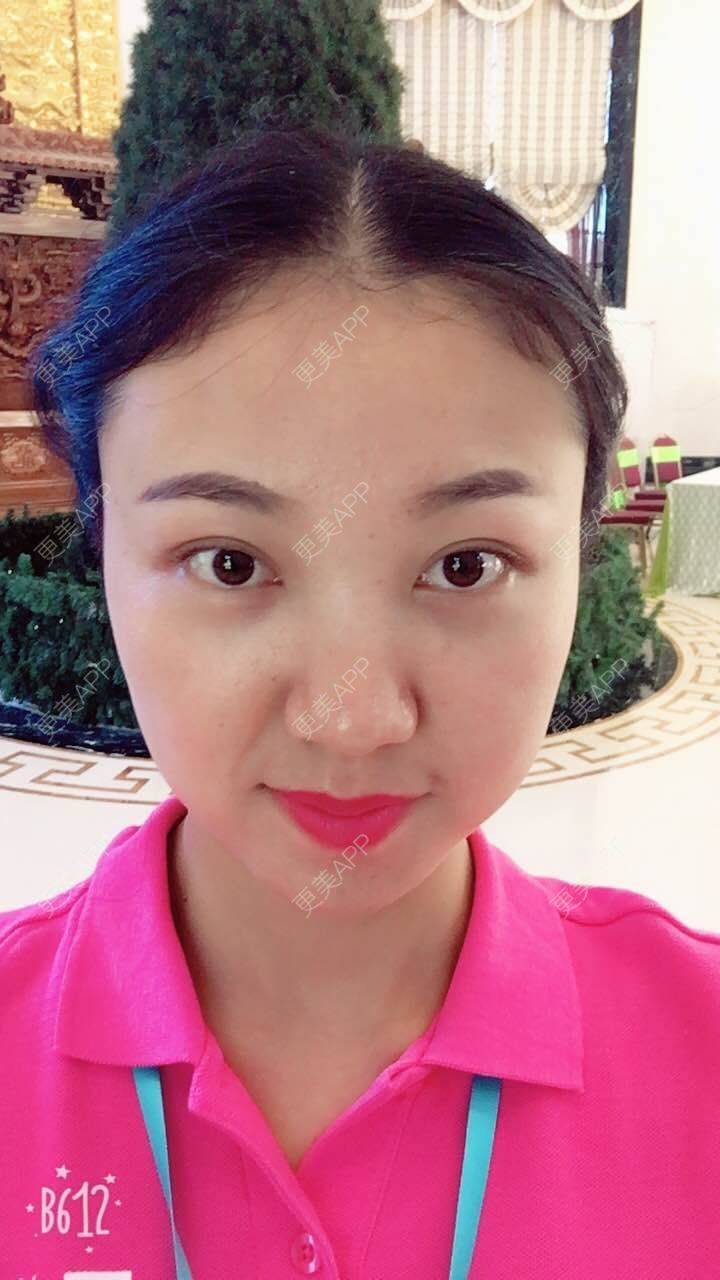 更美 - 刘文峰 医生的内切去眼袋经验 | 内切去眼袋