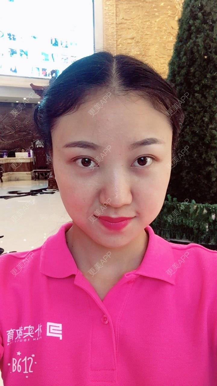 更美 - 刘文峰 医生的内切去眼袋经验 | 内切去眼袋