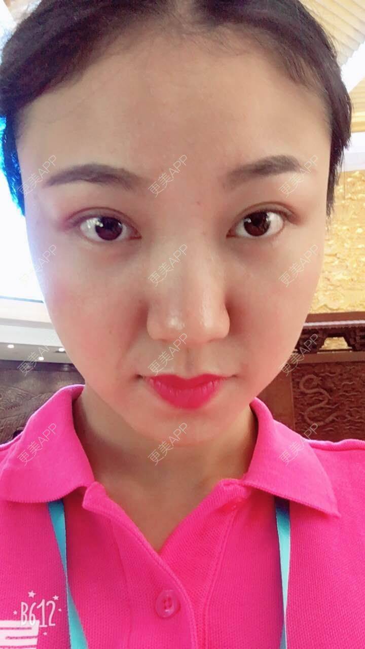 更美 - 刘文峰 医生的内切去眼袋经验 | 内切去眼袋