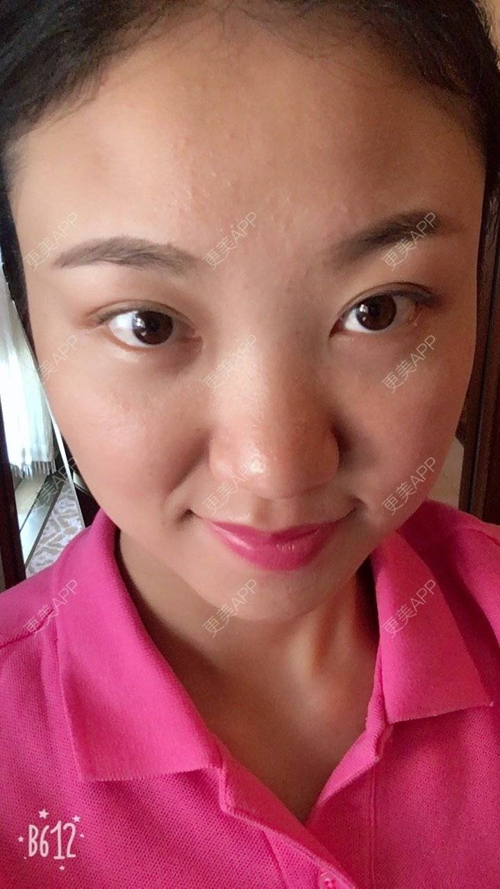 更美 - 刘文峰 医生的内切去眼袋经验 | 内切去眼袋