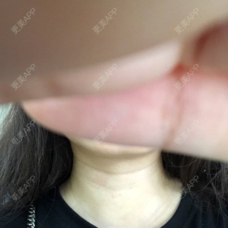 更美 - 麻薯嘉嘉的超声提升经验 | 丰胸（隆胸） | 北京 | 皮肤综合管理套餐 | 双眼皮 | 除皱 | 上海 | 假体隆胸 | 鼻部综合 | 武汉 | 长沙 | 南昌 | 沈阳 | 深圳 | 牙贴面 | 南宁 | 自体脂肪全面部填充 | 水氧活肤 | 郑州 | 杭州 | 吸脂 | 超声提升 | 除皱瘦脸 | 玻尿酸 | 果酸焕肤