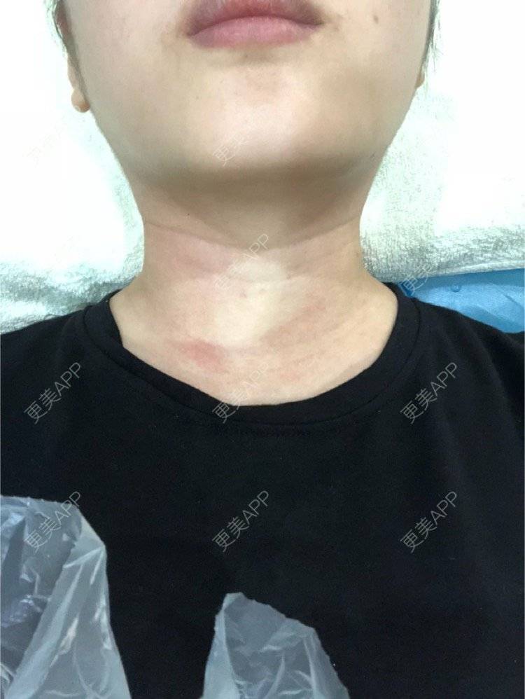 更美 - 麻薯嘉嘉的超声提升经验 | 丰胸（隆胸） | 北京 | 皮肤综合管理套餐 | 双眼皮 | 除皱 | 上海 | 假体隆胸 | 鼻部综合 | 武汉 | 长沙 | 南昌 | 沈阳 | 深圳 | 牙贴面 | 南宁 | 自体脂肪全面部填充 | 水氧活肤 | 郑州 | 杭州 | 吸脂 | 超声提升 | 除皱瘦脸 | 玻尿酸 | 果酸焕肤