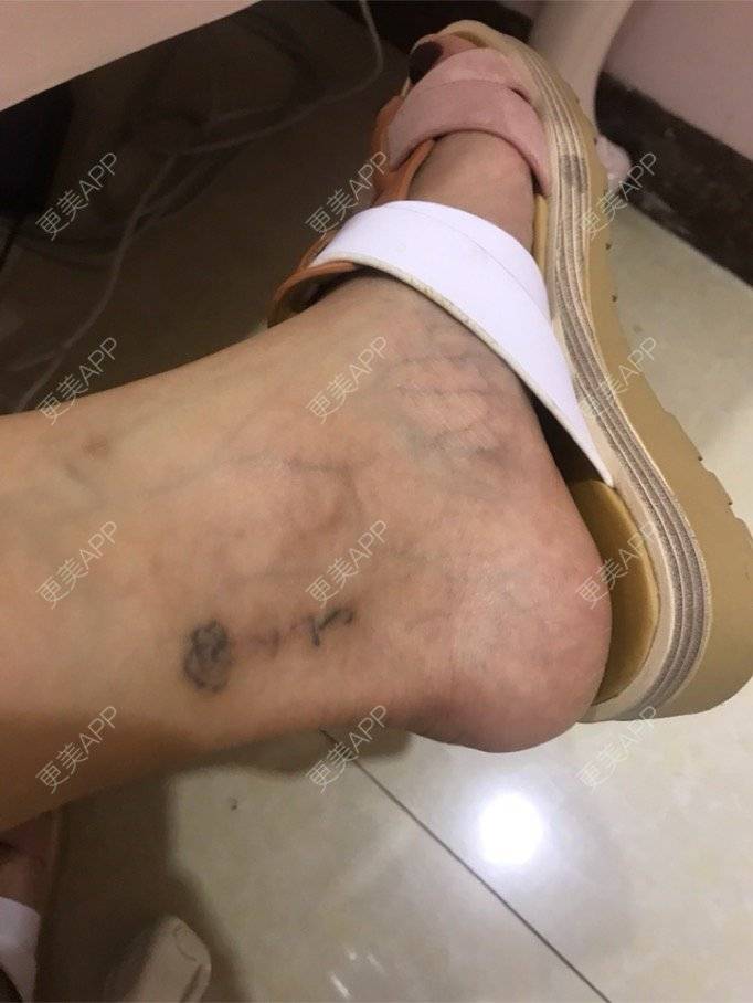 更美 - 更美用户3222258361的祛斑祛色素经验 | 洗纹身 | 祛斑祛色素 | 广州