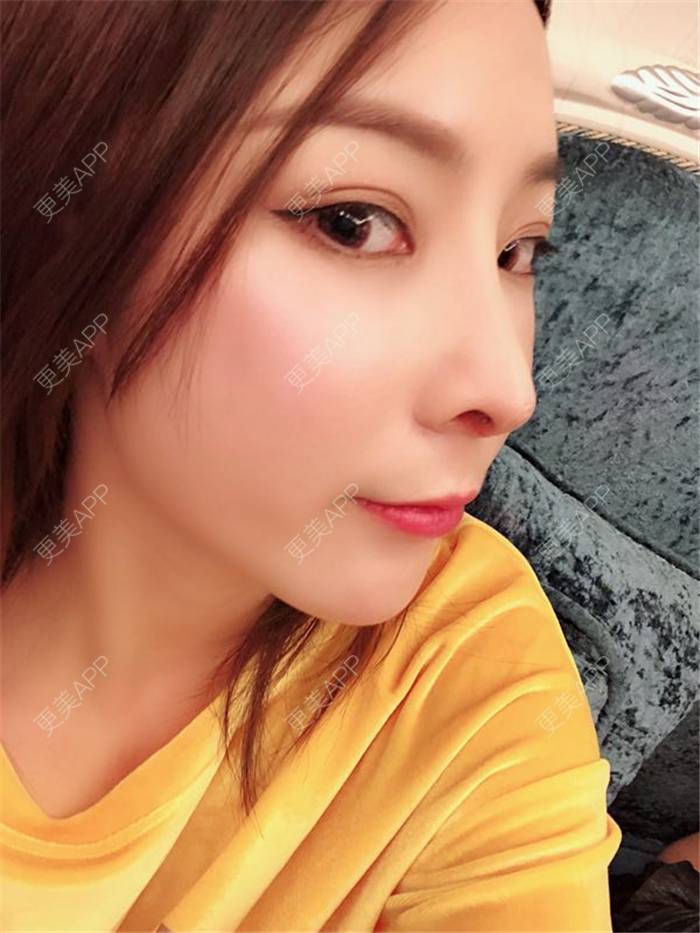 更美用户ctoboquuwe的肋软骨隆鼻日记