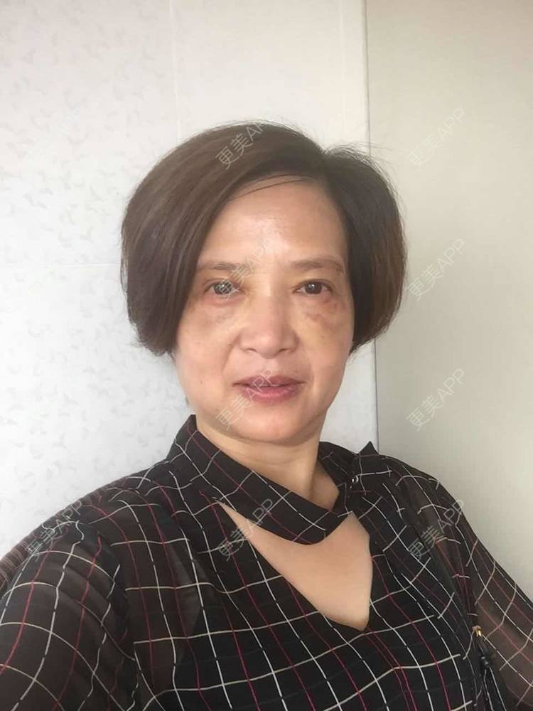 陪你过冬天的外切去眼袋日记