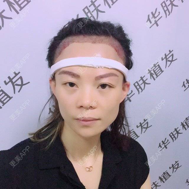 更美 - 更美用户8IMX2zVDl2的植发际线经验 | 植发际线 | 种植眉毛 | 重庆