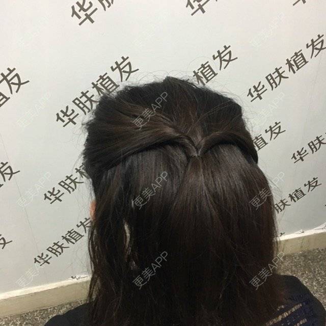 更美 - 更美用户8IMX2zVDl2的植发际线经验 | 植发际线 | 种植眉毛 | 重庆