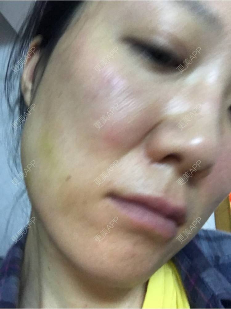更美 - 舒怡的经验 | 自体脂肪隆胸 | 自体脂肪丰太阳穴 | 硅胶隆鼻 | 水光项目 | 牙齿矫正 | 双眼皮 | 上海 | 北京 | 除皱瘦脸 | 武汉 | 埋线提升 | 长沙 | 广州 | 牙贴面 | 深圳 | 南昌 | 南京 | 鼻部综合