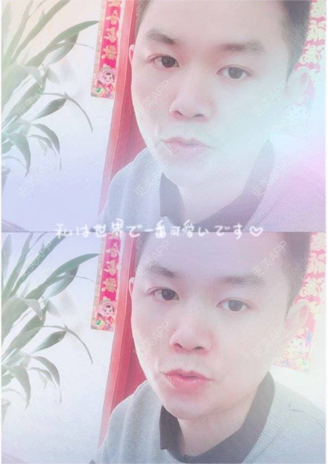 更美 - 小小祥子的M唇成形经验 | M唇成形 | 视频日记 | 重庆 | 厚唇改薄 | 唇综合