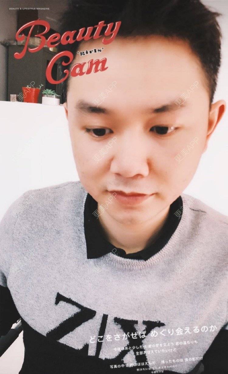 更美 - 小小祥子的M唇成形经验 | M唇成形 | 视频日记 | 重庆 | 厚唇改薄 | 唇综合