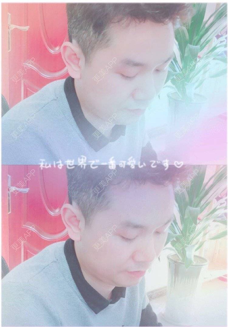 更美 - 小小祥子的M唇成形经验 | M唇成形 | 视频日记 | 重庆 | 厚唇改薄 | 唇综合