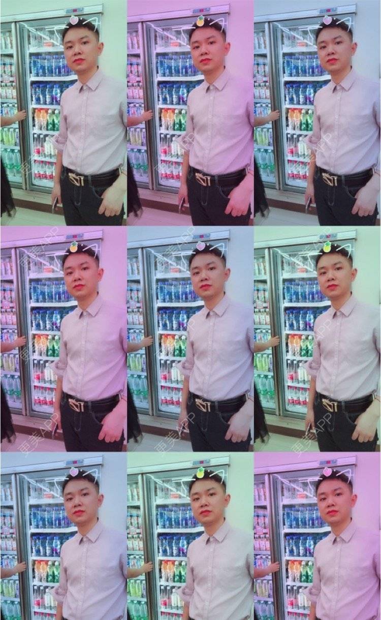 更美 - 小小祥子的M唇成形经验 | M唇成形 | 视频日记 | 重庆 | 厚唇改薄 | 唇综合