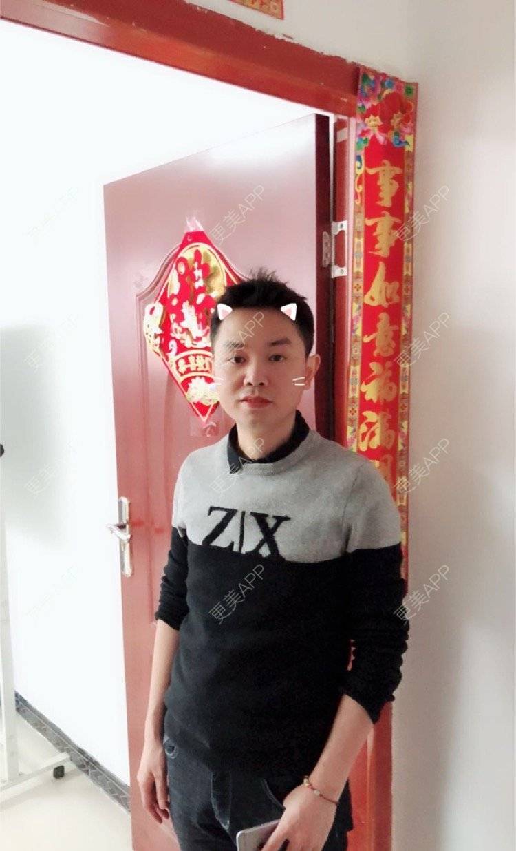 更美 - 小小祥子的M唇成形经验 | M唇成形 | 视频日记 | 重庆 | 厚唇改薄 | 唇综合