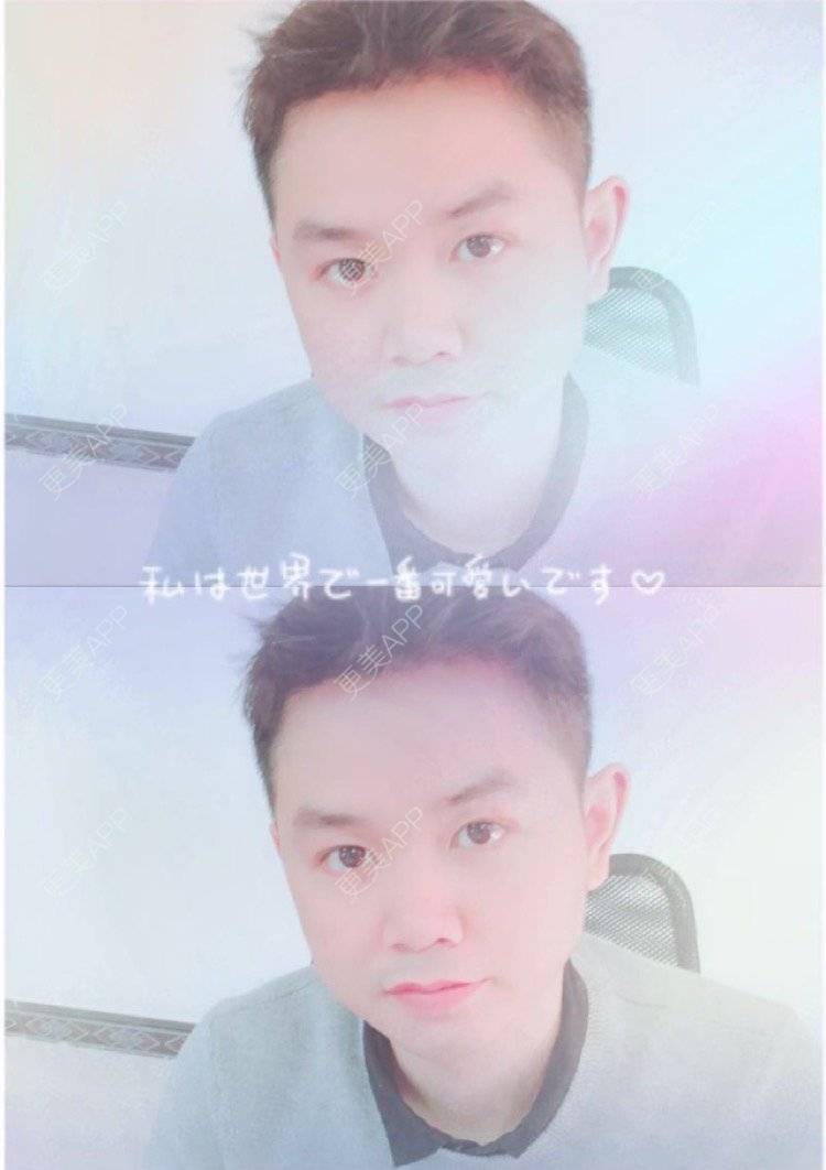 更美 - 小小祥子的M唇成形经验 | M唇成形 | 视频日记 | 重庆 | 厚唇改薄 | 唇综合