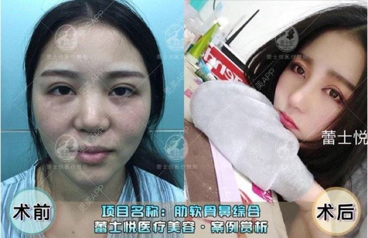 更美 - 李海兵 医生的硅胶隆鼻经验 | 北京 | 硅胶隆鼻