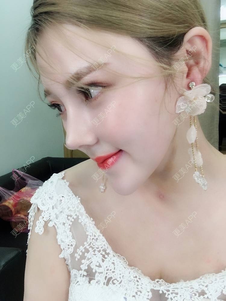 惜泪c的耳软骨隆鼻日记