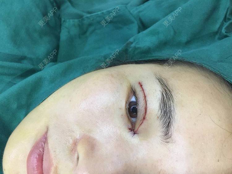 更美用户lrifkqtxfq的双眼皮日记