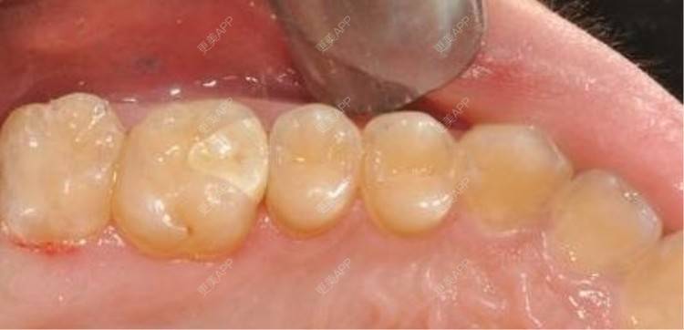 更美用户dmn2eggcaj的补牙日记