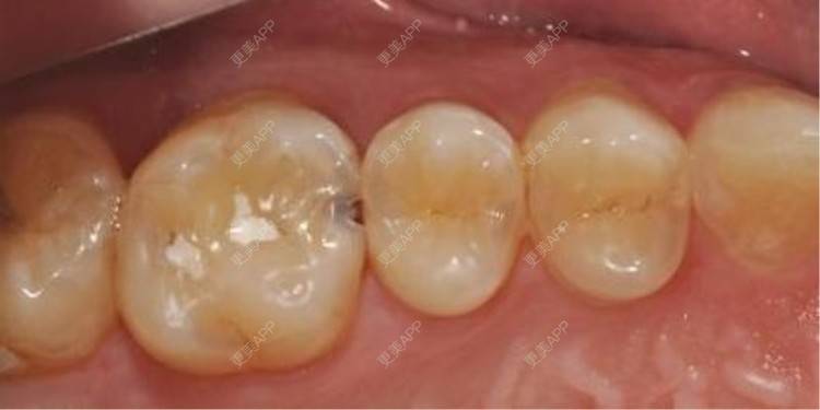 更美用户dmn2eggcaj的补牙日记