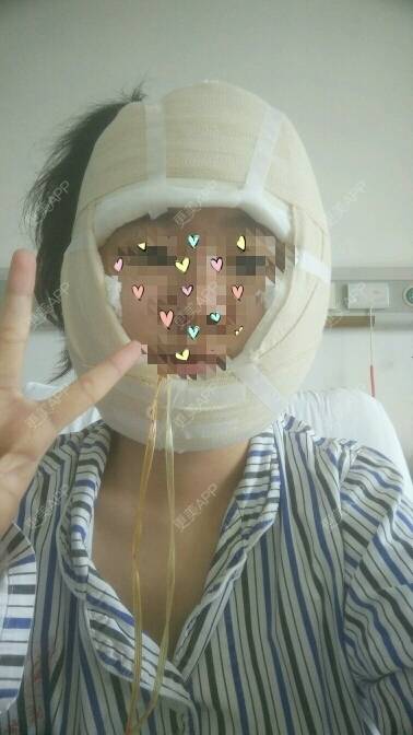 更美 - 更美用户s1ZheVmQm6的下颌角经验 | 西安 | 重庆 | 自体脂肪丰太阳穴 | 杭州 | 下颌角 | 玻尿酸溶解酶 | 除皱瘦脸 | 武汉 | 广州 | 全切双眼皮