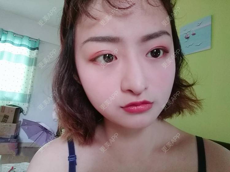 更美 - 米格m的鼻部多项经验 | 膨体隆鼻 | 广州 | 隆鼻 | 鼻部多项
