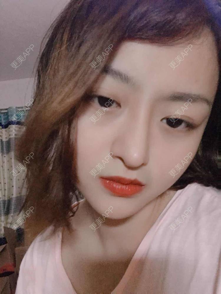 更美 - 米格m的鼻部多项经验 | 膨体隆鼻 | 广州 | 隆鼻 | 鼻部多项