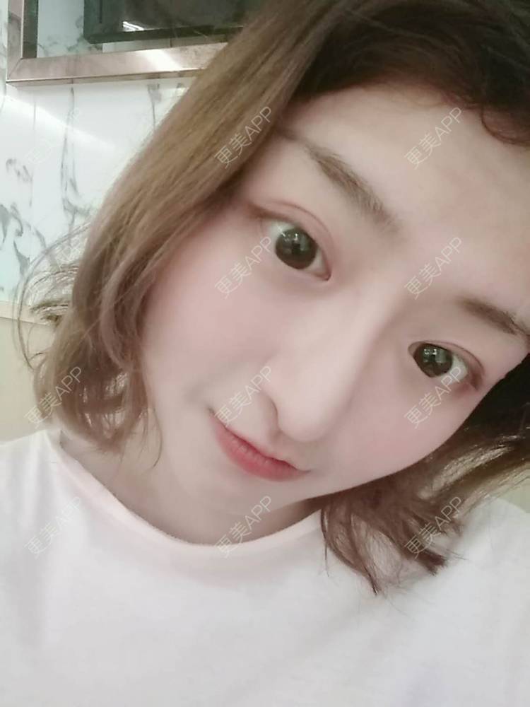 更美 - 米格m的鼻部多项经验 | 膨体隆鼻 | 广州 | 隆鼻 | 鼻部多项