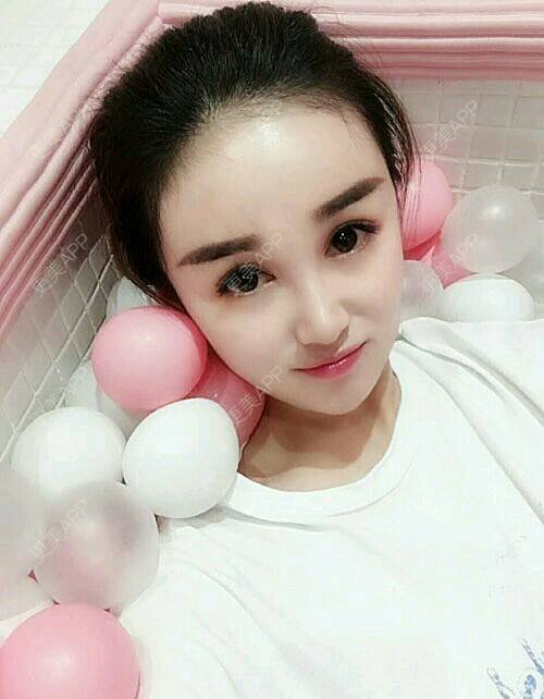 美琳娜的定点双眼皮日记