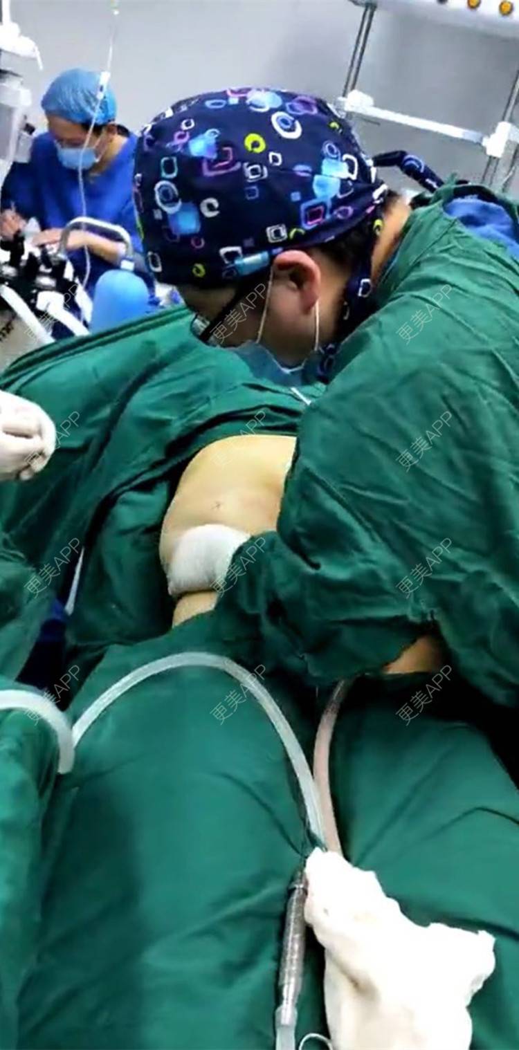 吸脂瘦大腿手术_七彩玫瑰1吸脂瘦大腿手术_术后4天__更美整形