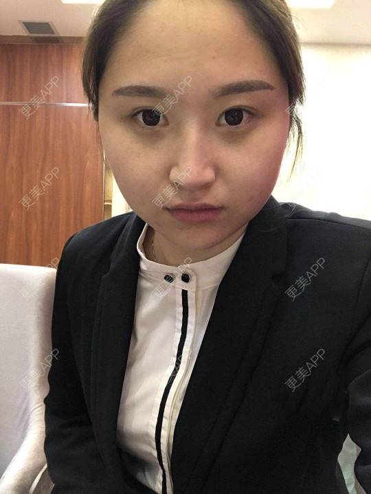 更美 - 深冬入暖的经验 | 埋线提升 | 广州