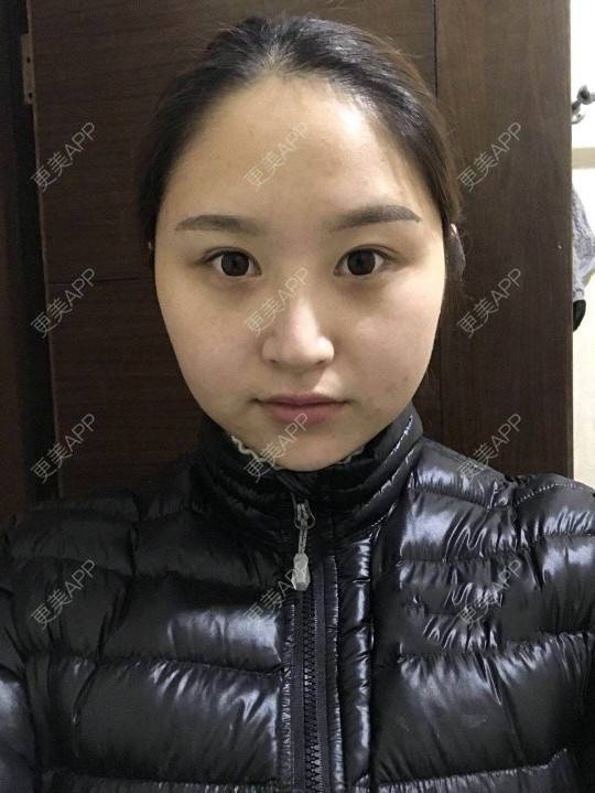 更美 - 深冬入暖的经验 | 埋线提升 | 广州