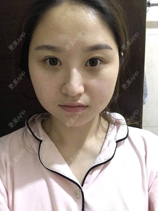 更美 - 深冬入暖的经验 | 埋线提升 | 广州